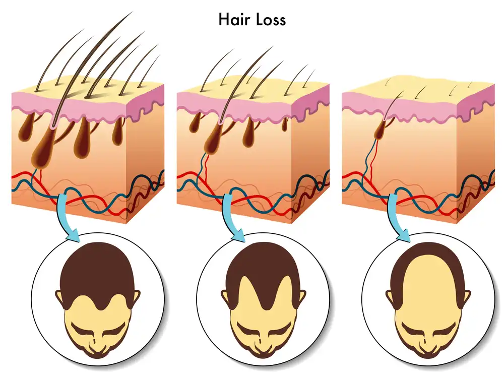 NMNは薄毛を治療する
